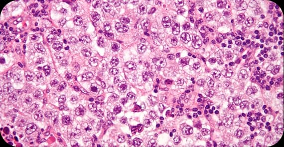 Germ Cell Tumours