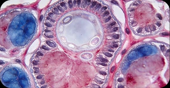 Gastrointestinal Stromal Tumour (GIST)