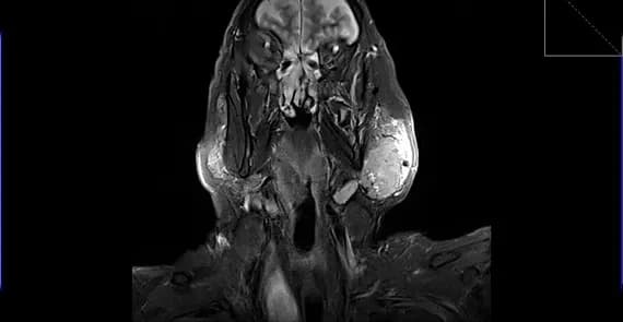 Unilateral Warthin’s