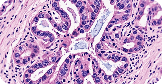 Adenocarcinoma