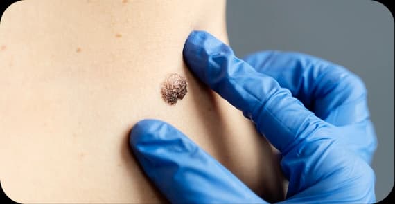 Squamous Cell Carcinoma