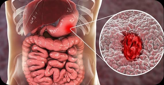 Gastrointestinal Stromal Tumours (GIST)