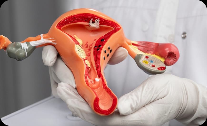 What Is Ovarian Cancer?