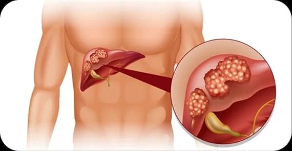 Secondary Liver Cancer