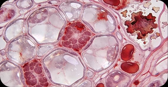 Renal Cell Carcinoma