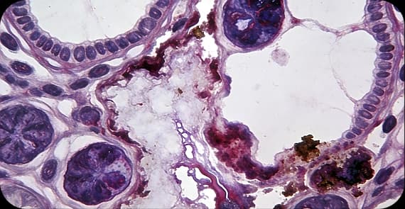 Small Cell Carcinoma