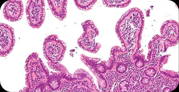 Non-Hodgkin Lymphoma