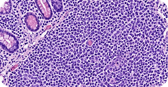 Lymphoma