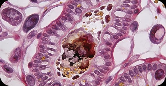 Ductal Adenocarcinoma