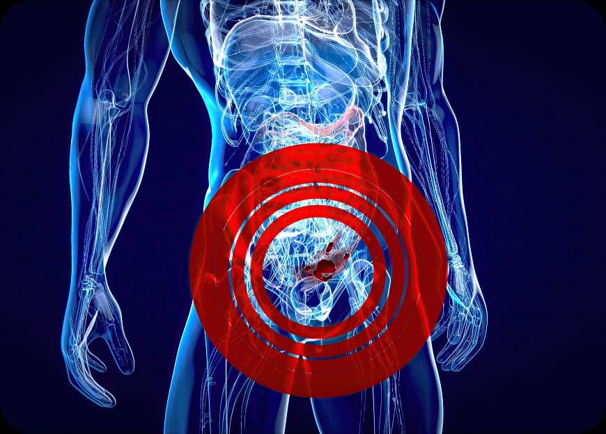 Causes of Colon Cancer