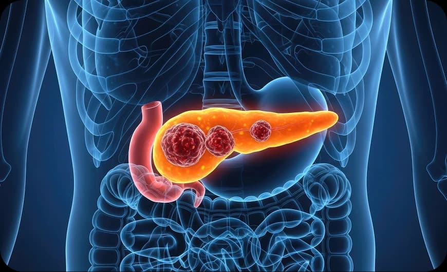 What Is Pancreatic Cancer?