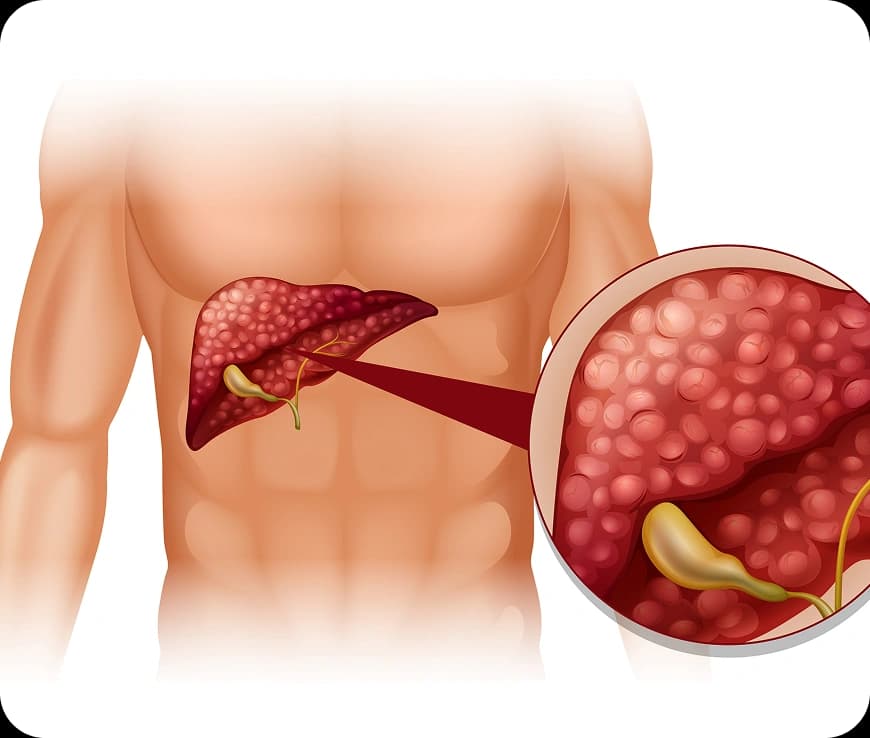 Bile Duct Cancer Stages Explained