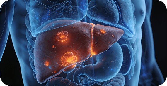 Metastatic Liver Cancer